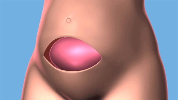 Cleveland Clinic animation of a fetal surgery to repair spina bifida.