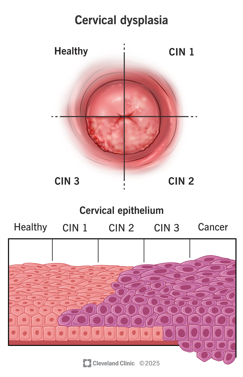 The amount of abnormal epithelial cells increases as the CIN stage increases from 1 to 3