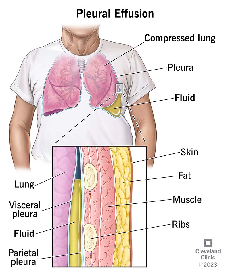 Excess fluid collecting between the layers of your pleura is pleural effusion.